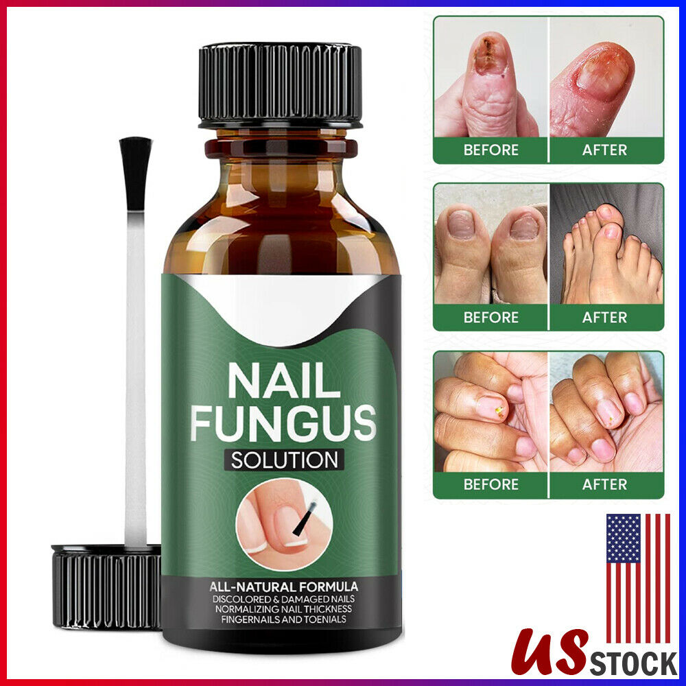 Anti-Pilz Nagel Treatment