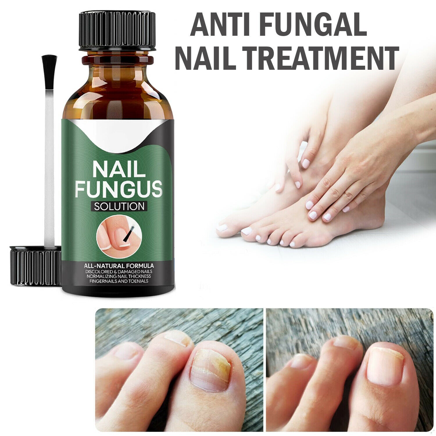Anti-Pilz Nagel Treatment
